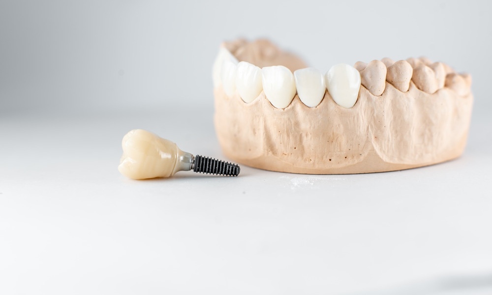 Understanding the Lifelike Aesthetic Benefits of Modern Dental Implants