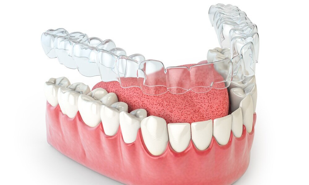 The Invisible Transformation: Unveiling the Benefits of Invisalign Treatment
